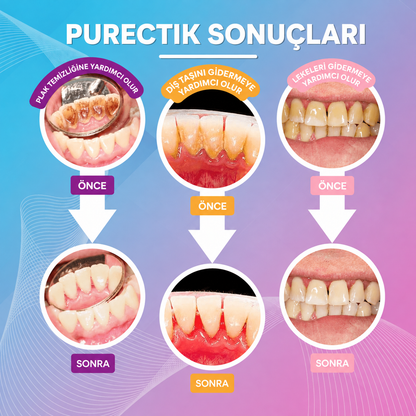 Purectik™ Ultrasonik Diş Temizleme Cihazı